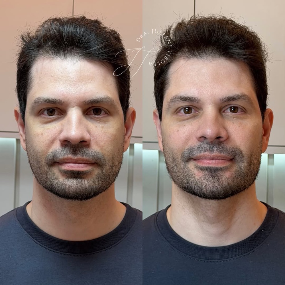 Resultado de procedimento de harmonização facial